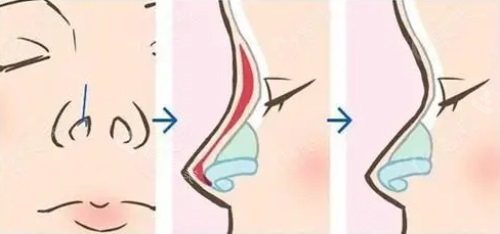隆鼻示意图 隆鼻示意图