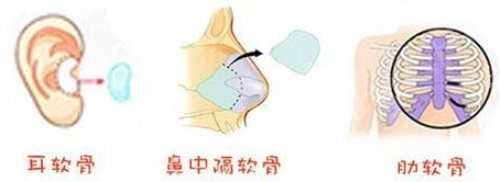 软骨隆鼻示意图 软骨隆鼻示意图