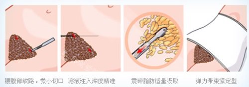腰部吸脂示意图 腰部吸脂示意图