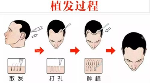 植發(fā)過(guò)程示意圖 植發(fā)過(guò)程示意圖