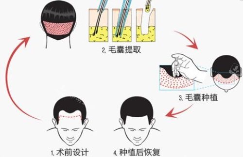 毛囊提取示意圖 毛囊提取示意圖