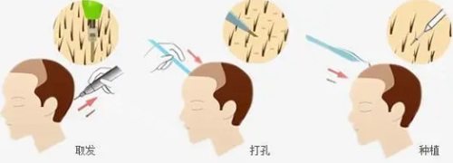 毛囊種植示意圖 毛囊種植示意圖