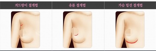 韩国Faceplus整形医院隆胸切口