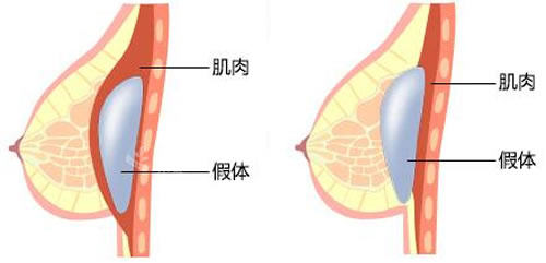 韩国NJH卢钟勋整形外科隆胸技术特点分析