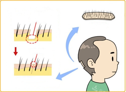 植发过程示意图