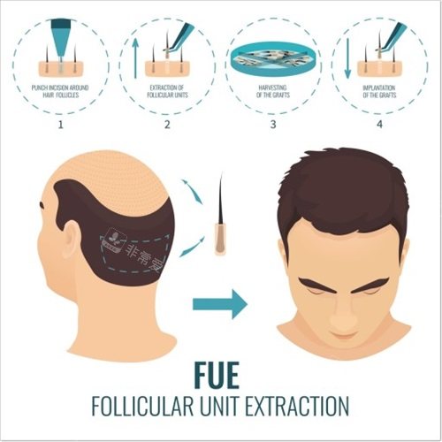 FUE無痕植發(fā)過程示意圖 FUE無痕植發(fā)過程示意圖
