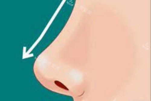 隆鼻手术展示图