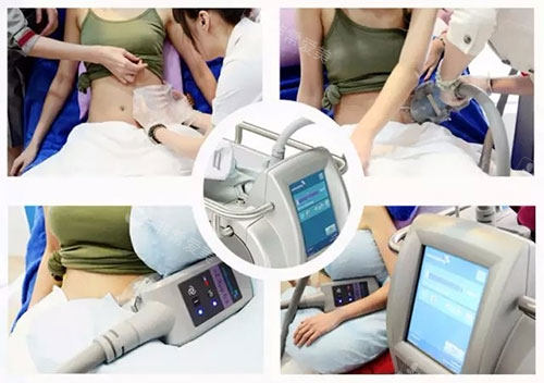 腰部冷冻溶脂技术图 腰部冷冻溶脂技术图