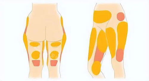 大腿吸脂部位图片 大腿吸脂部位图片