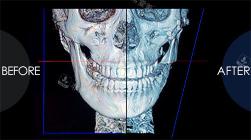 真人点评韩国芭堂轮廓修复过程,采用3D骨修复更加精细化!