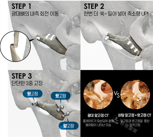 韩国芭堂颧骨手术过程图