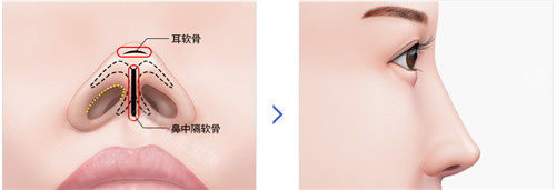 韩国dream整形鼻整形怎么样？初鼻鼻矫正鼻修复能力都很强
