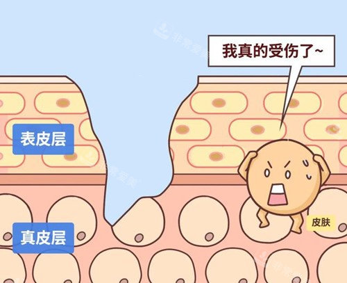 皮膚受損示意圖 皮膚受損示意圖