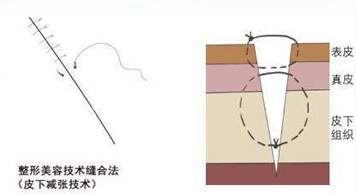 减张缝合示意图