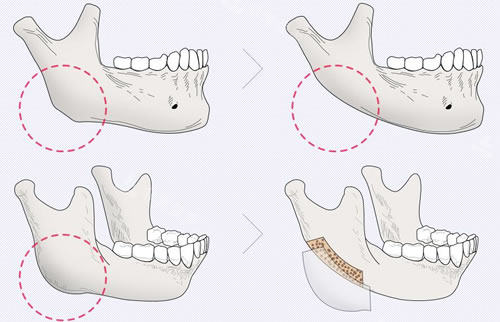 韩国NJH卢钟勋整形外科下颌角截骨优势分析