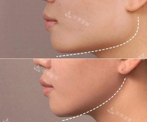 韩国NJH卢钟勋整形外科下颌角截骨特点展示