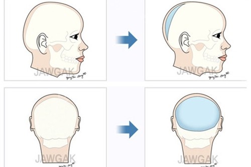 骨水泥填充后腦勺