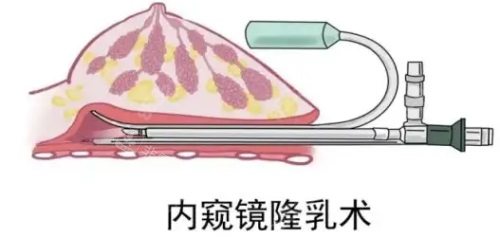 韩国凯伦秀隆胸怎么样？多少钱？隆胸技术优势及费用分享