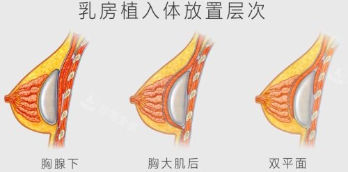 韩国凯伦秀隆胸怎么样？多少钱？隆胸技术优势及费用分享