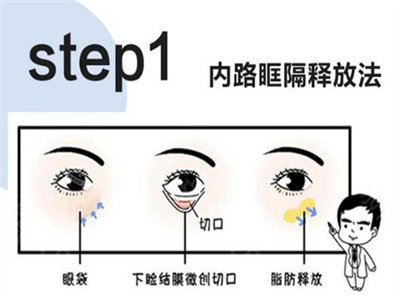 內(nèi)切去眼袋手術(shù)過程 內(nèi)切去眼袋手術(shù)過程