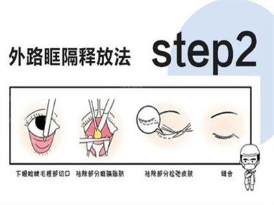 外切祛眼袋手術(shù)過程 外切祛眼袋手術(shù)過程