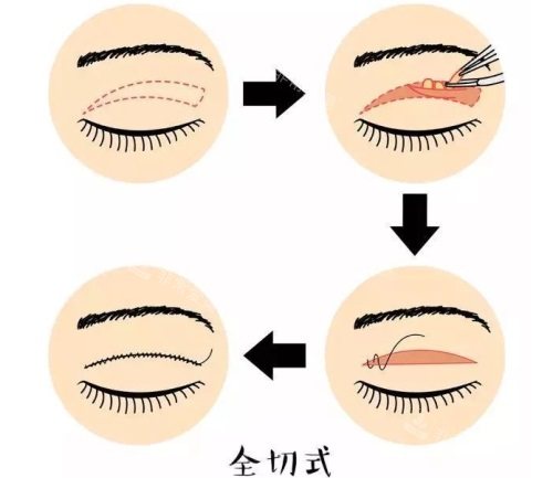 全切双眼皮示意图