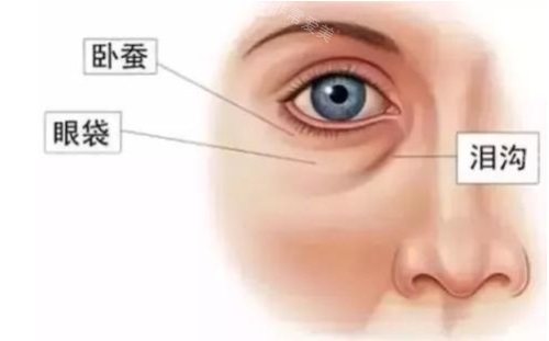 眼袋位置示意图 眼袋位置示意图