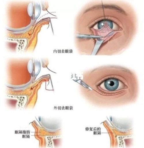 祛眼袋方式 祛眼袋方式