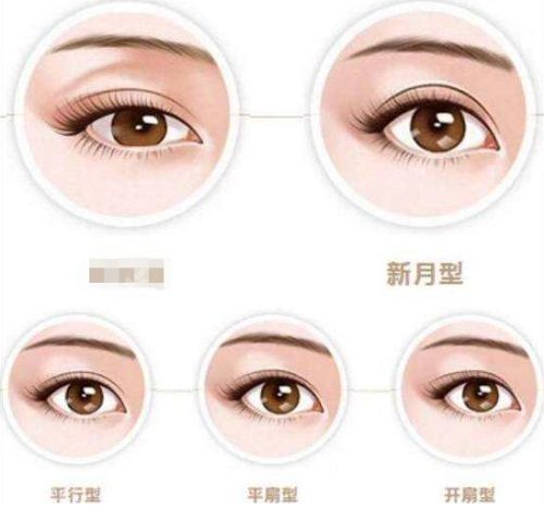 不同类型的双眼皮 不同类型的双眼皮