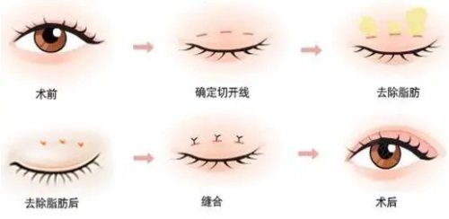 双眼皮过程图 双眼皮过程图