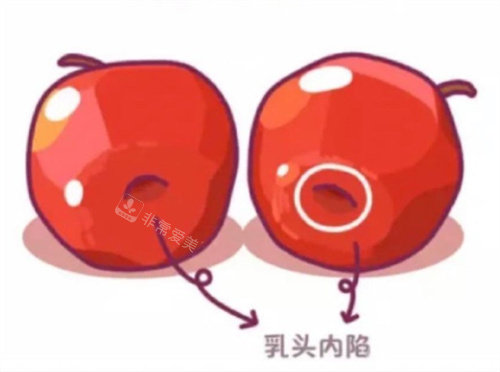 乳頭內(nèi)陷卡通圖