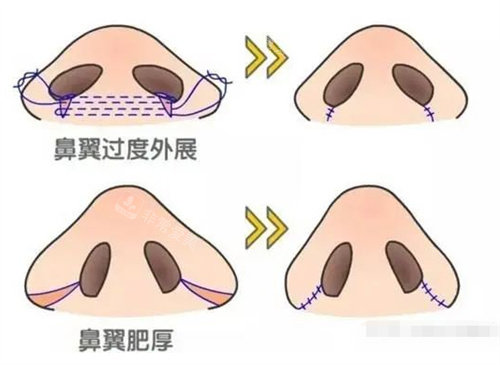 鼻翼肥厚示意圖