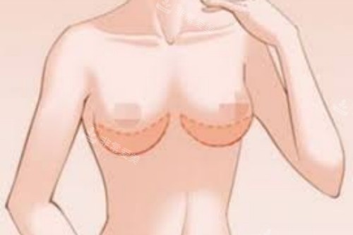 韩国VG百利酷整形外科隆胸手术为何出名 三个特点大有可观