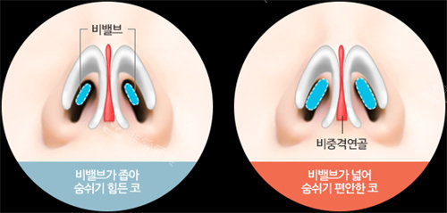 韩国芭堂隆鼻修复怎么样?通过真实患者的自述来了解!