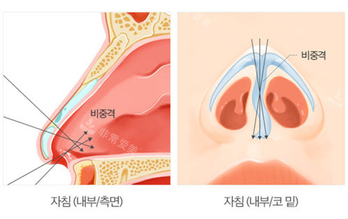 韩国芭堂隆鼻修复怎么样?通过真实患者的自述来了解!