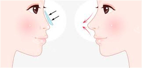 隆鼻硅胶假体示意图