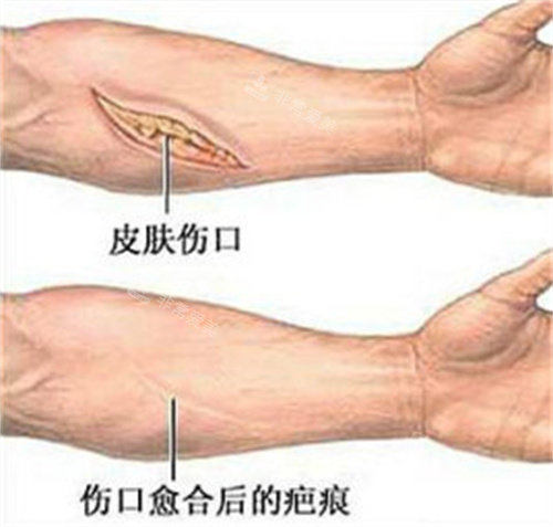 术后后愈合疤痕示意图