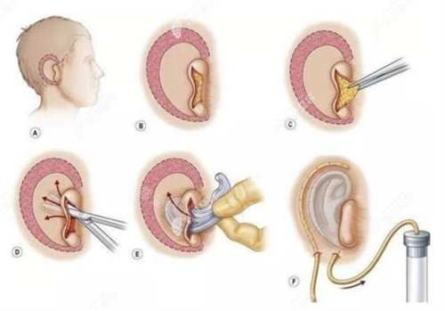 耳朵手术过程图