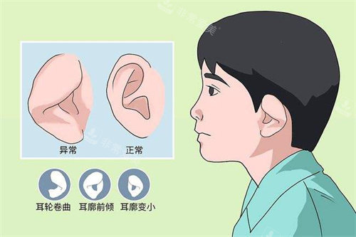 成都小耳整形示意图