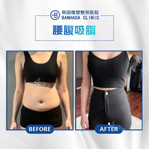 韓國微塑整形醫(yī)院腰腹吸脂對比 韓國微塑整形醫(yī)院腰腹吸脂對比