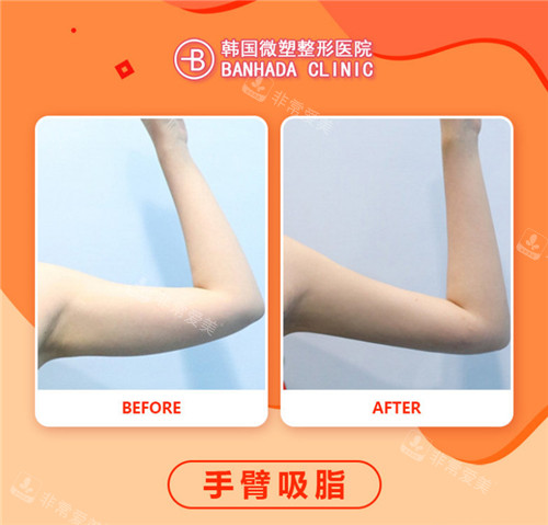韓國微塑整形醫(yī)院手臂吸脂對比 韓國微塑整形醫(yī)院手臂吸脂對比