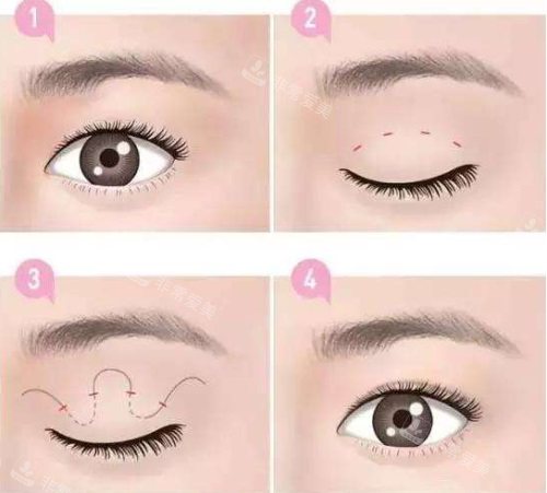 双眼皮过程图 双眼皮过程图