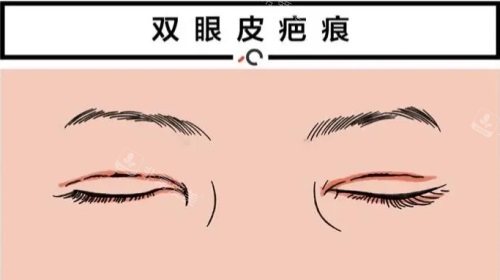 双眼皮疤痕修复图 双眼皮疤痕修复图