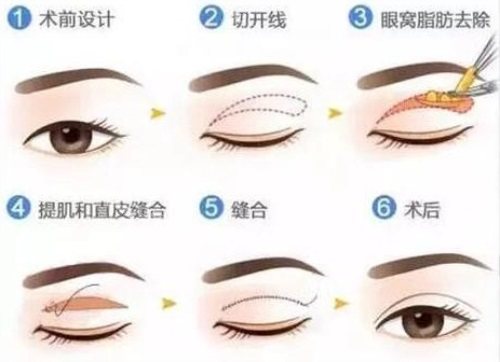 双眼皮手术过程图 双眼皮手术过程图