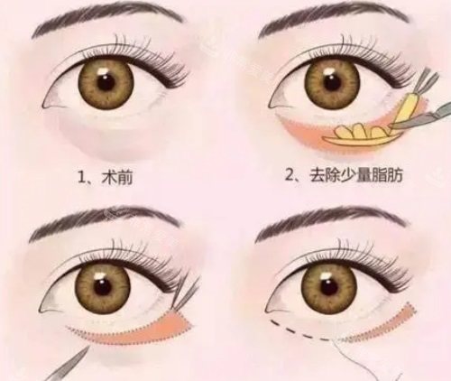 祛眼袋过程图 祛眼袋过程图