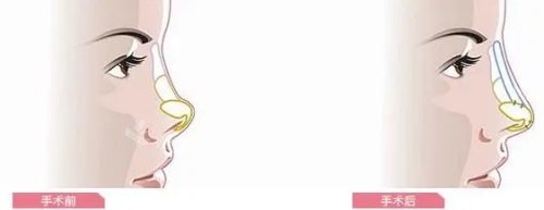 隆鼻对比图 隆鼻对比图