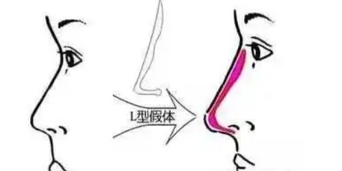 假体隆鼻示意图 假体隆鼻示意图