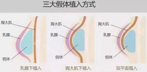 假体隆胸植入方式示意图