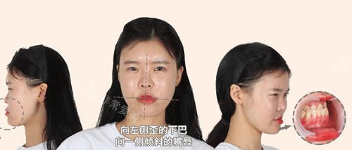術(shù)前面部歪斜問題圖片