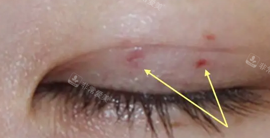 眼部手术细节图 眼部手术细节图